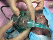 争分夺秒 与死神赛跑——我院新生儿科成功抢救危重极早早产、超低出生体重“龙凤胎” 